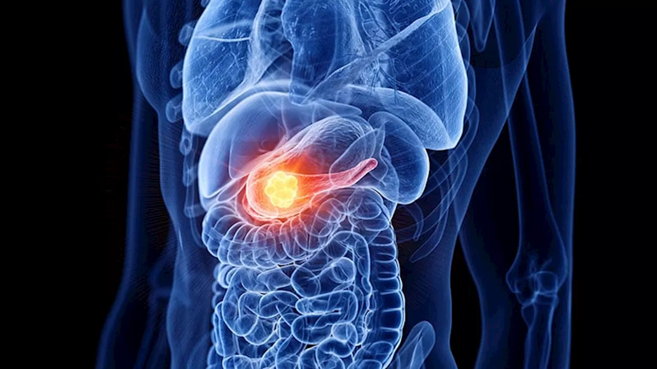 Recurrent Pancreatitis Triples Risk for Chronic Disease