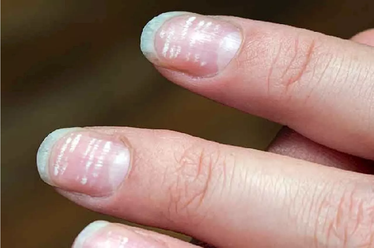 White Spots on Nails: మీ గోర్లపై ఈ తెలుపు మచ్చలున్నాయా, అయితే ఈ వ్యాధుల ముప్పు ఉన్నట్టే