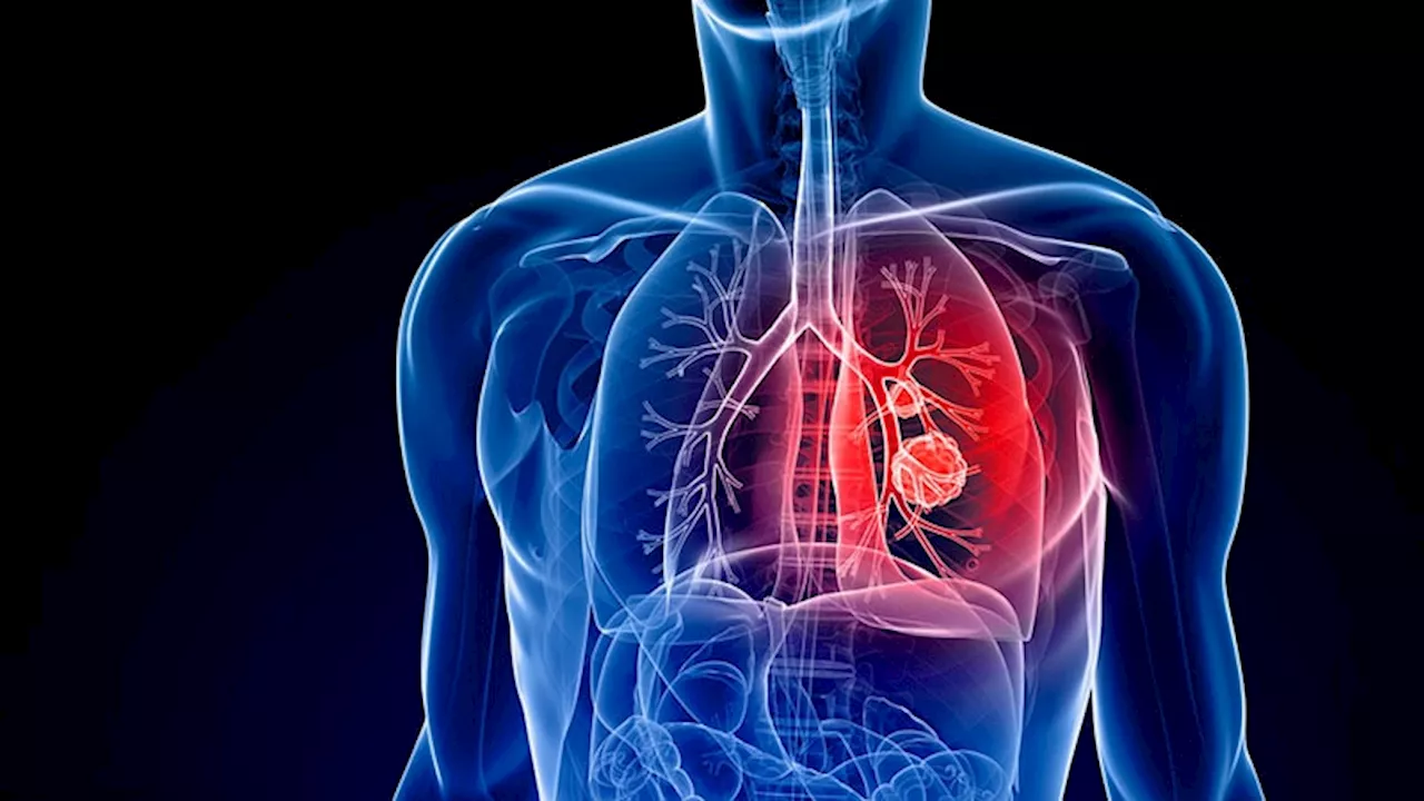 Rheumatoid Arthritis and RA-Associated Interstitial Lung Disease Linked to Higher Lung Cancer Risk