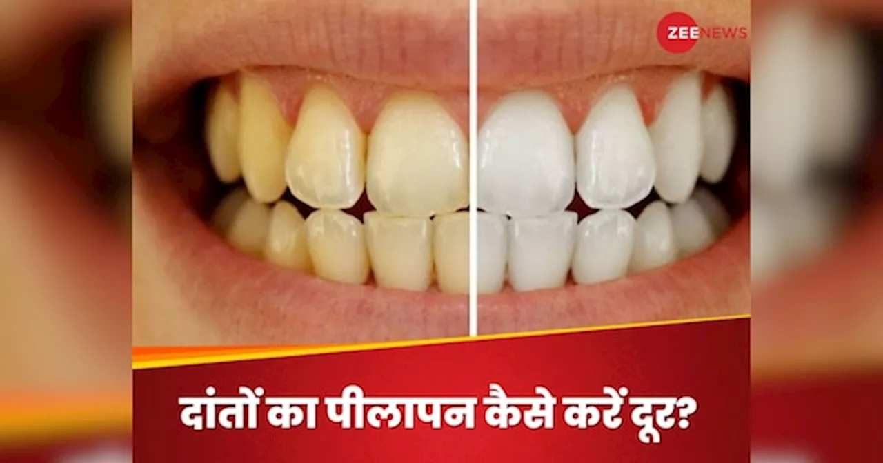 Teeth Whitening: दांतों के पीलेपन ने छीन लिया आपका कॉन्फिडेंस? इस तरह वापस पाएं मोतियों जैसी चमक