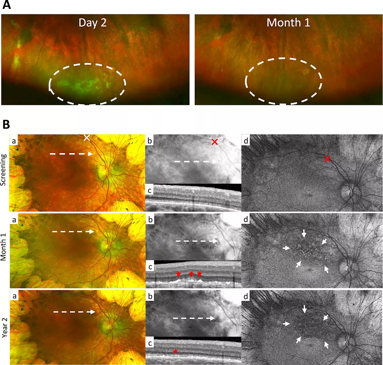 Gene therapy found to be effective in hereditary blindness