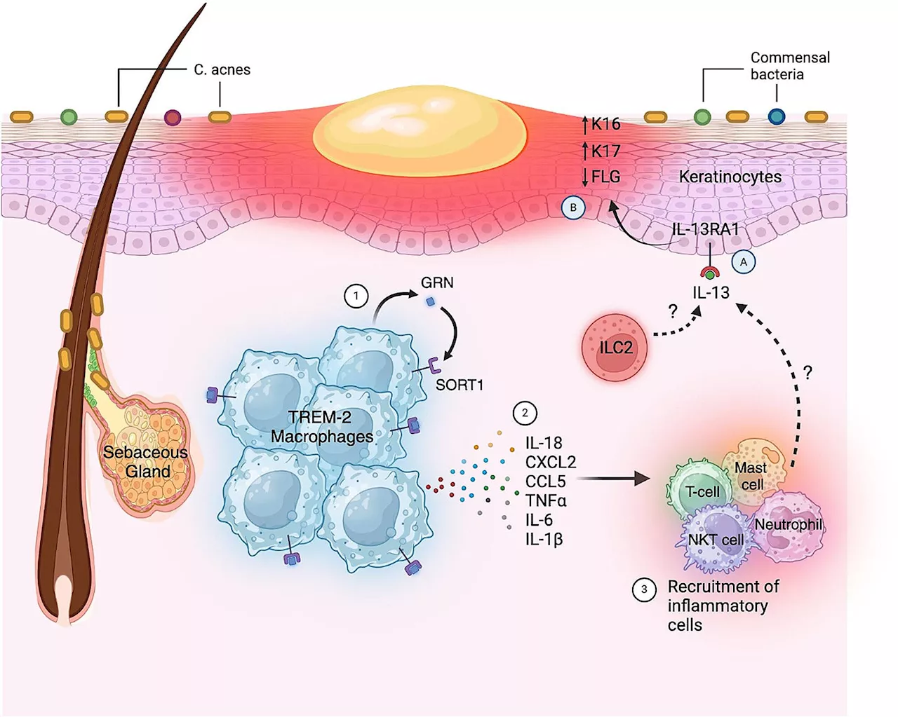 Researchers identify cellular pathways whose dysregulation leads to acne lesions