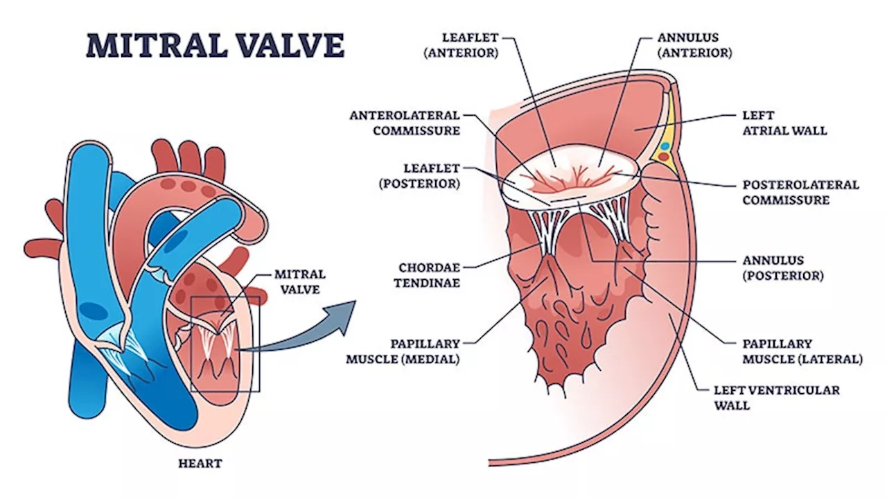 Large Trials Support Mitral Valve Repair in Heart Failure