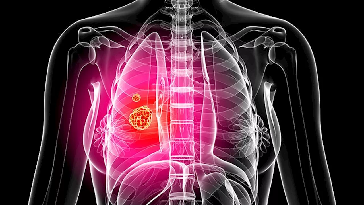 Osimertinib/Savolitinib Combo Shows Promise in NSCLC