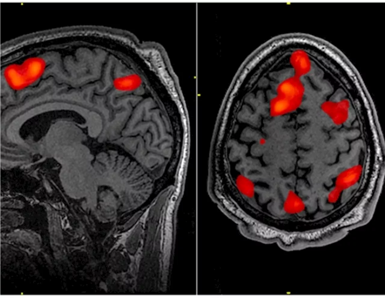 New normative neuroimaging library sets standard for brain injury research