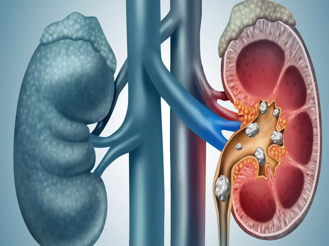 Kidney Stone: કિડનીમાં પથરી વધારે છે આ 5 શાકભાજી, ખાતા હોય તો આજથી કરી દેજો બંધ