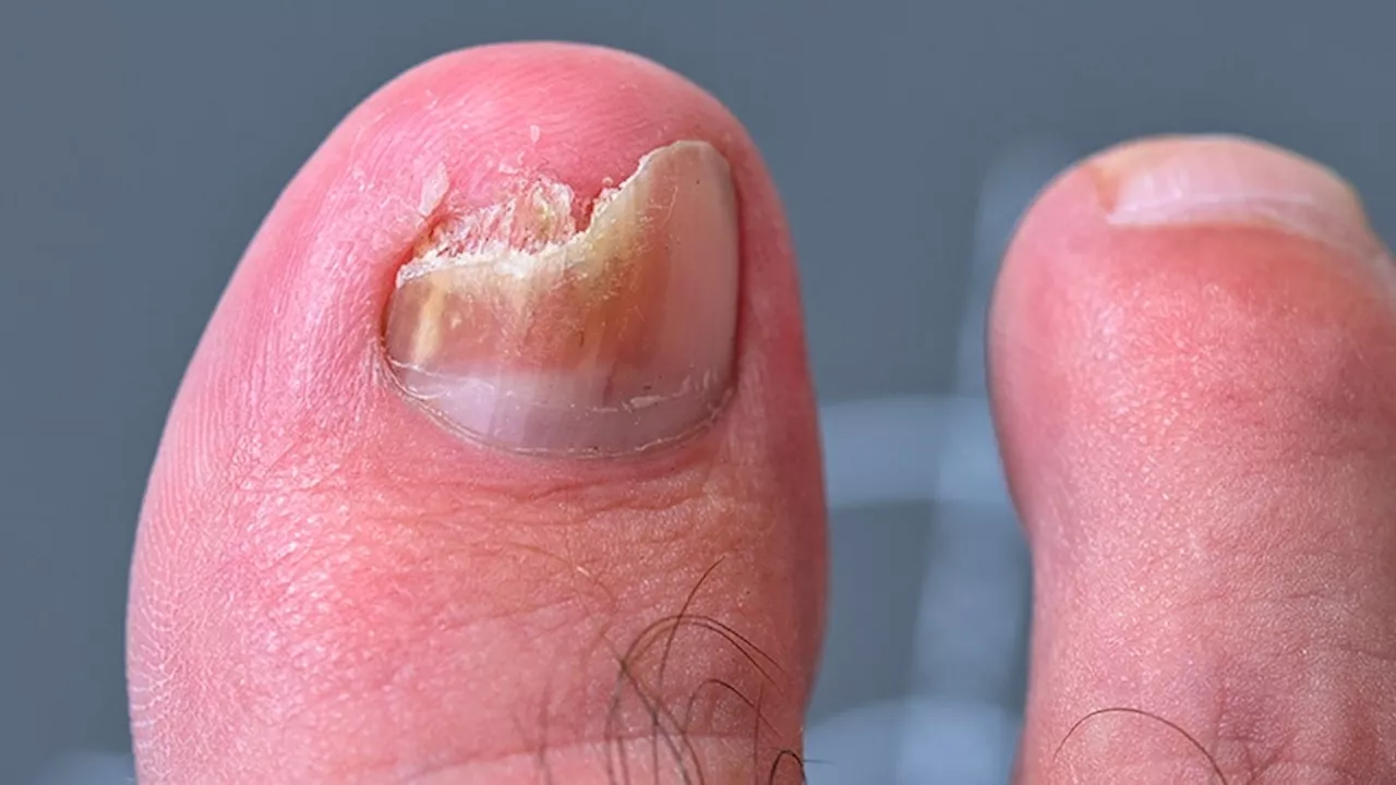 Nailfold Capillaroscopy Reveals Key Features of Nail Diseases