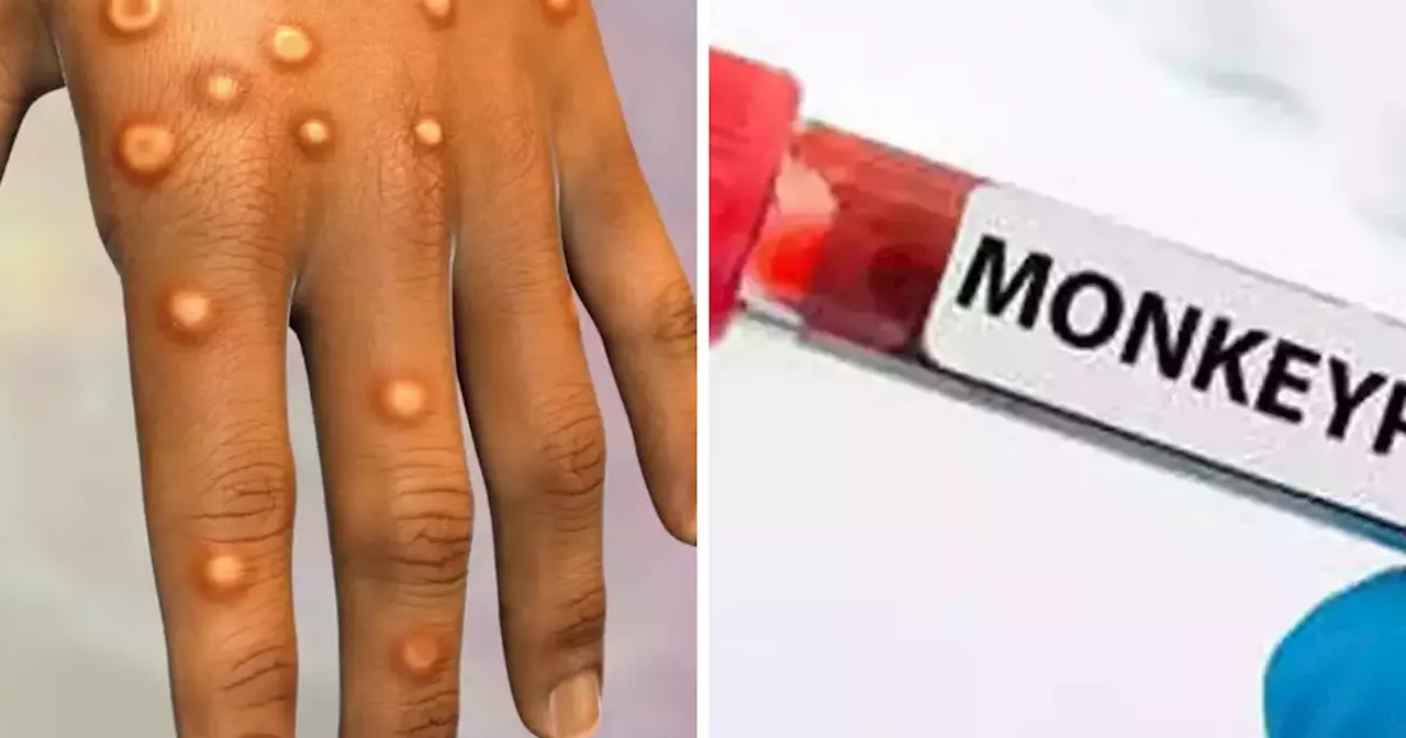 दिल्ली आया Monkeypox, अस्पताल में भर्ती मरीज में दिखे ये 2 लक्षण, WHO ने बताया दुनिया की सबसे घातक बीमारी