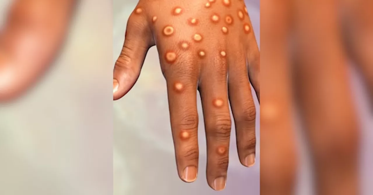 क्या कोरोना की तरह ही तांडव मचाएगा Mpox? जानें क्या हैं मंकीपॉक्स के लक्षण और इलाज