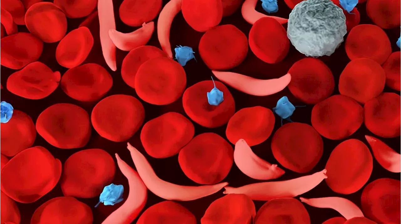 Sickle cell trait is prevalent among diverse human populations, study finds