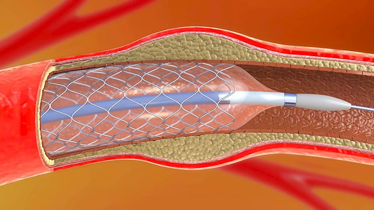 No Benefit to Anticoagulation After STEMI Revascularization