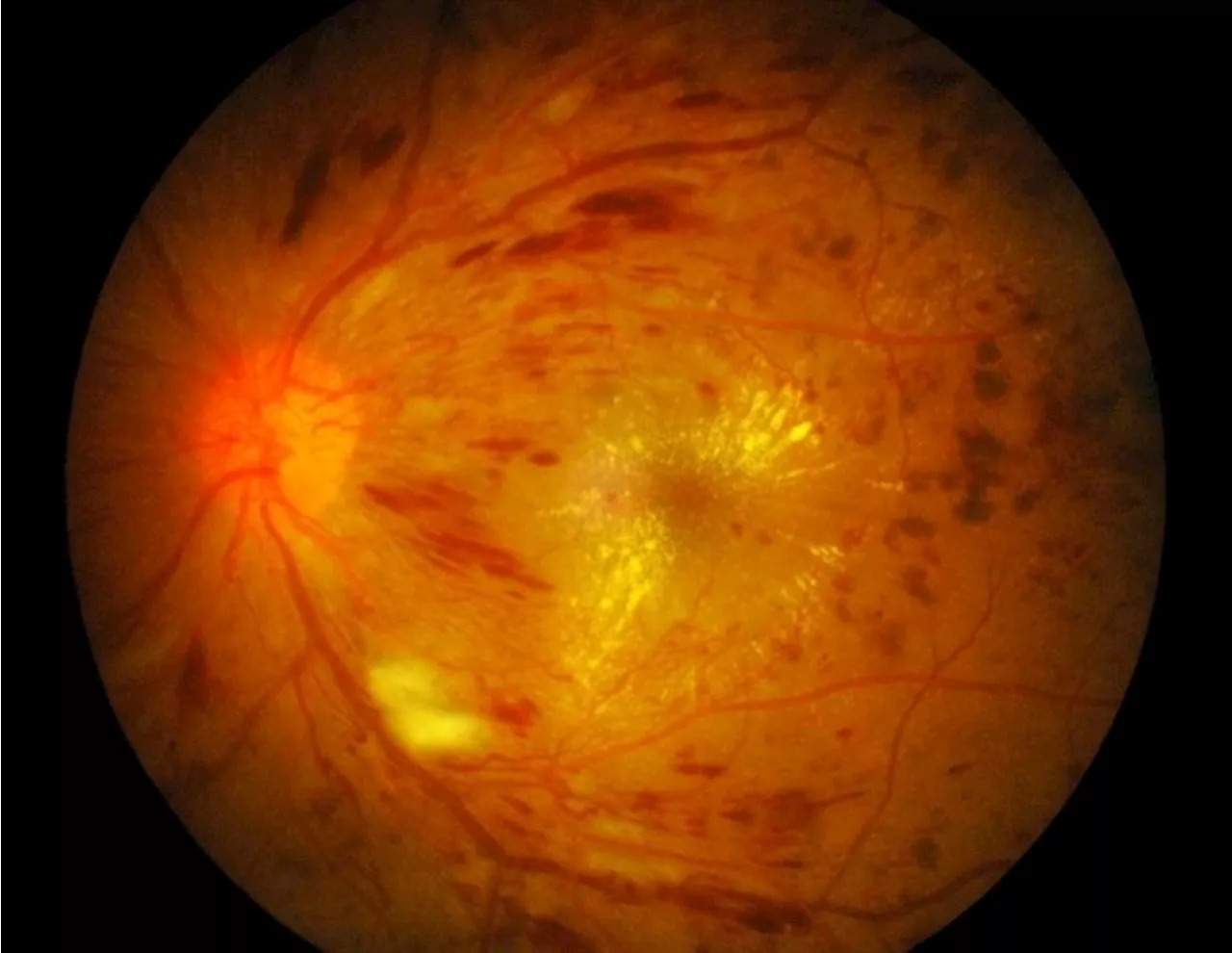 New research aims to target IL-6 for treating diabetic retinopathy