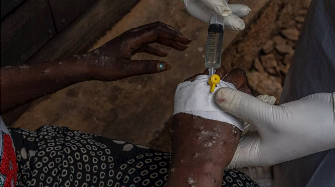 Epidémie de Mpox : un cas recensé au Maroc, le premier en Afrique du nord