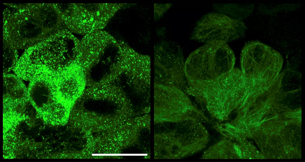 New therapy that targets and destroys tau tangles: A promising Alzheimer's disease treatment