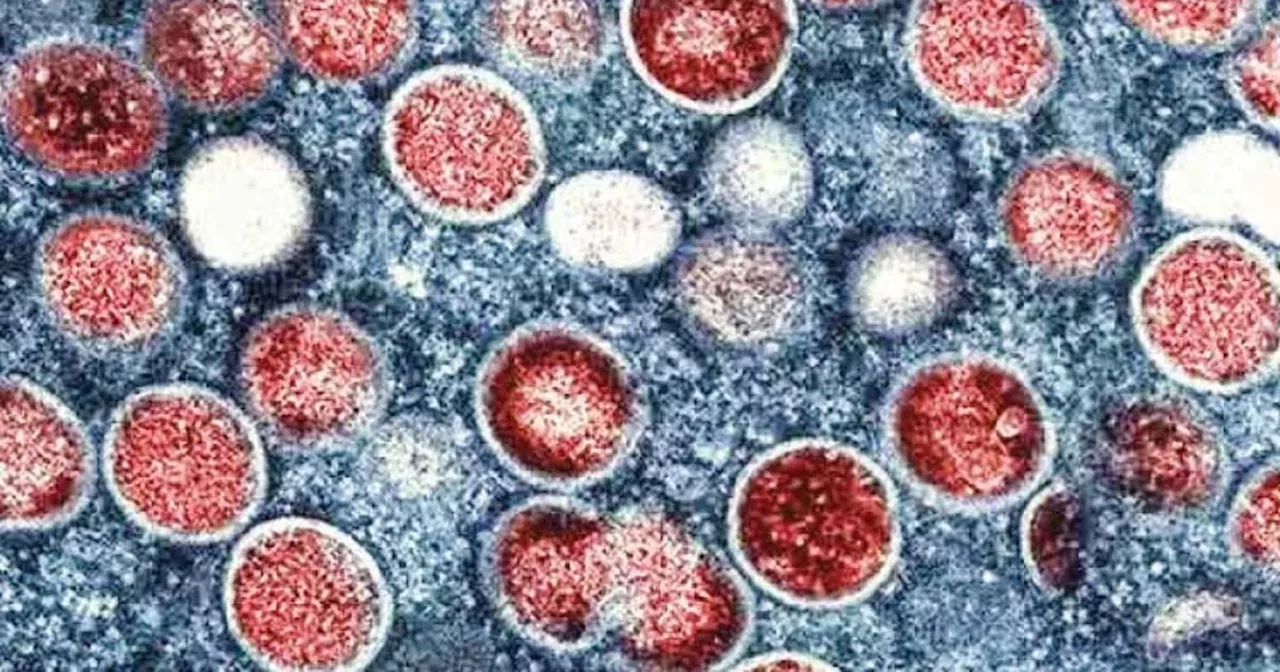 DOH 7 to validate 29 reported mpox cases