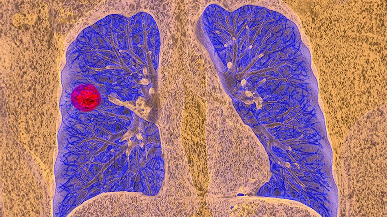 No DFS Benefit With Adjuvant Durvalumab in Early NSCLC