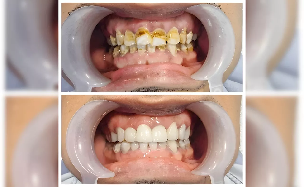 दांत पीले पड़ गए हैं? घर पर तैयार करें ये 4 आयुर्वेदिक मंजन, फिर से मोतियों की तरह चमक सकते हैं आपके Teeth
