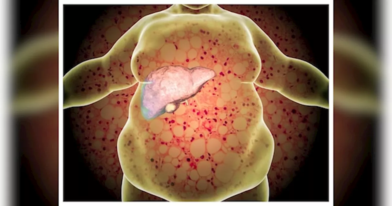 Fatty Liver : ये 7 लक्षण बताते हैं, आपके ल‍िवर में जम गया है फैट