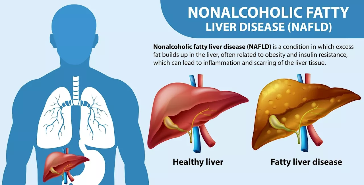 Higher soft drink consumption linked to increased risk of liver disease