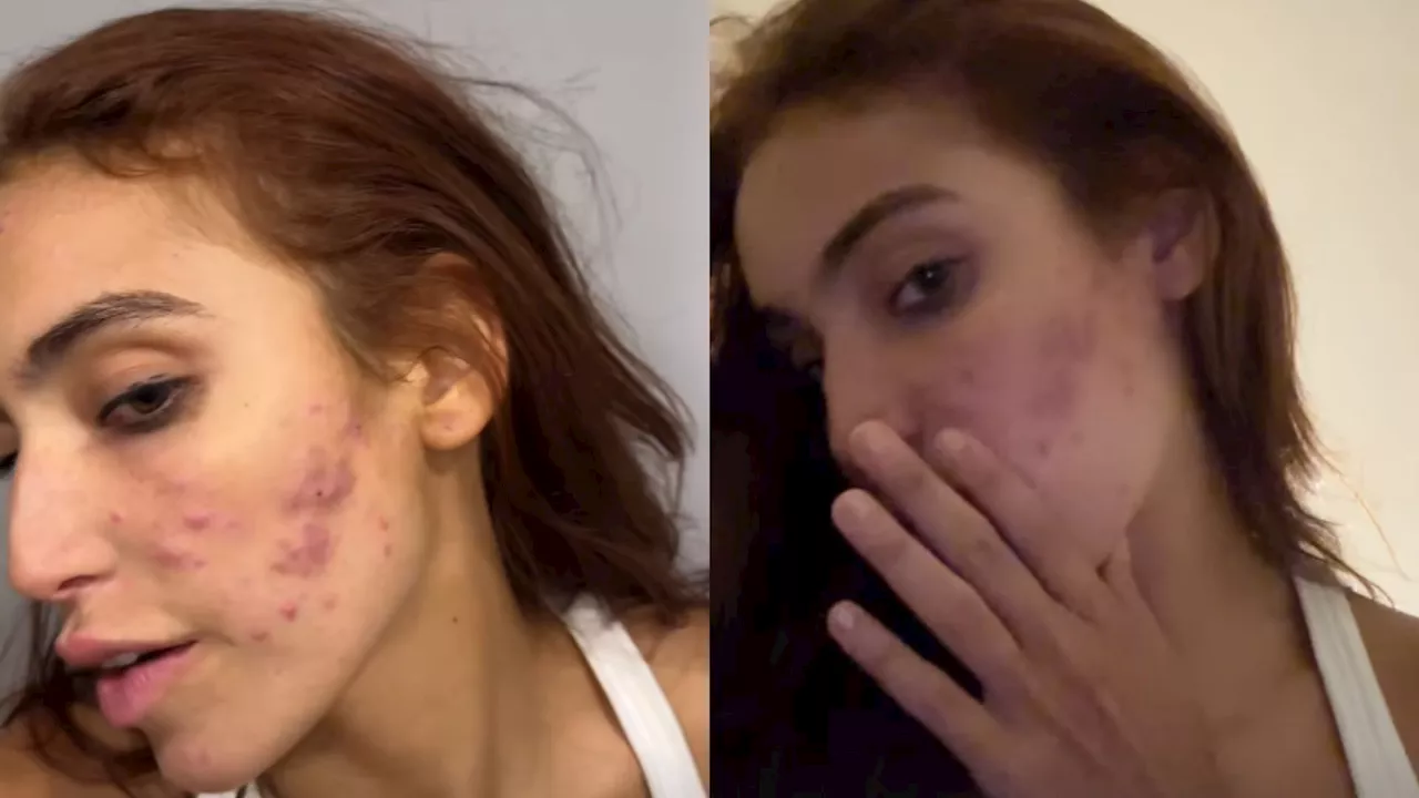 Vanessa Lopes volta a desabafar sobre acne: “Autoestima lá em baixo”