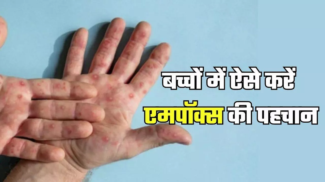 बच्चों को आसानी से अपना शिकार बना सकता है Mpox, जानें इसके फैलने का कारण और प्रमुख लक्षण