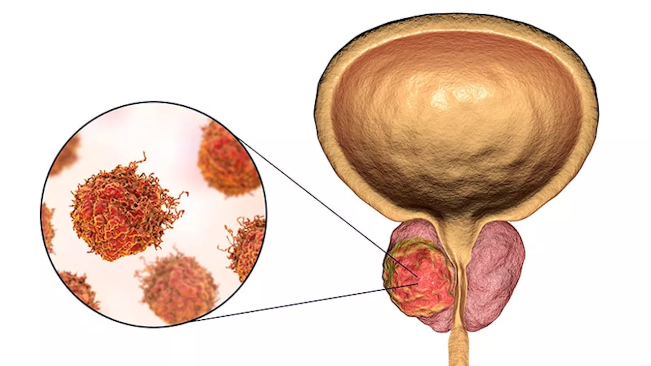 Radium-223 Plus EnzalutamideUps Survival in Metastatic Prostate Cancer