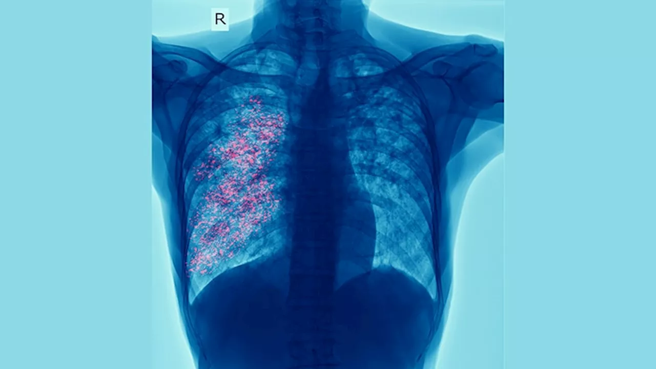 Valley Fever Risk Remains High in California This Fall