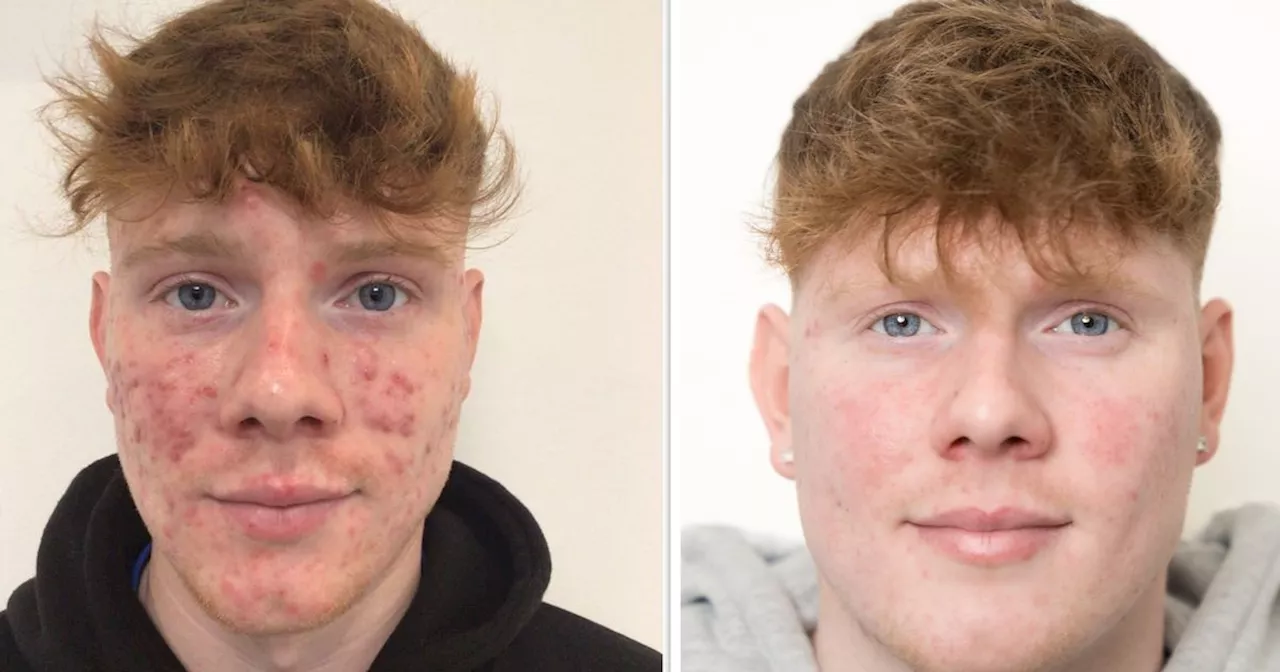 Rutherglen man has life transformed after year-long treatment cures severe acne