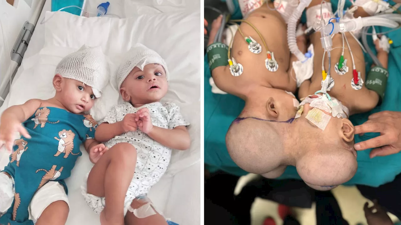 Conjoined twins who were fused at the head separated by British surgeon in marathon operation