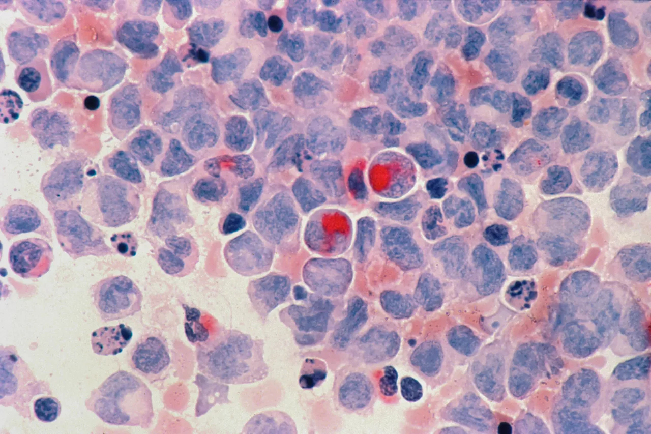 Novel treatment regimen yields promising response in advanced-phase chronic myeloid leukemia