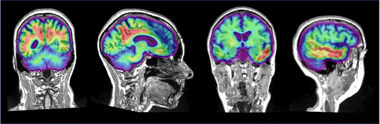 Understanding Changes in Pre-Clinical Alzheimer's Disease: Study Finds Two Proteins Impact Brain Activity Differently