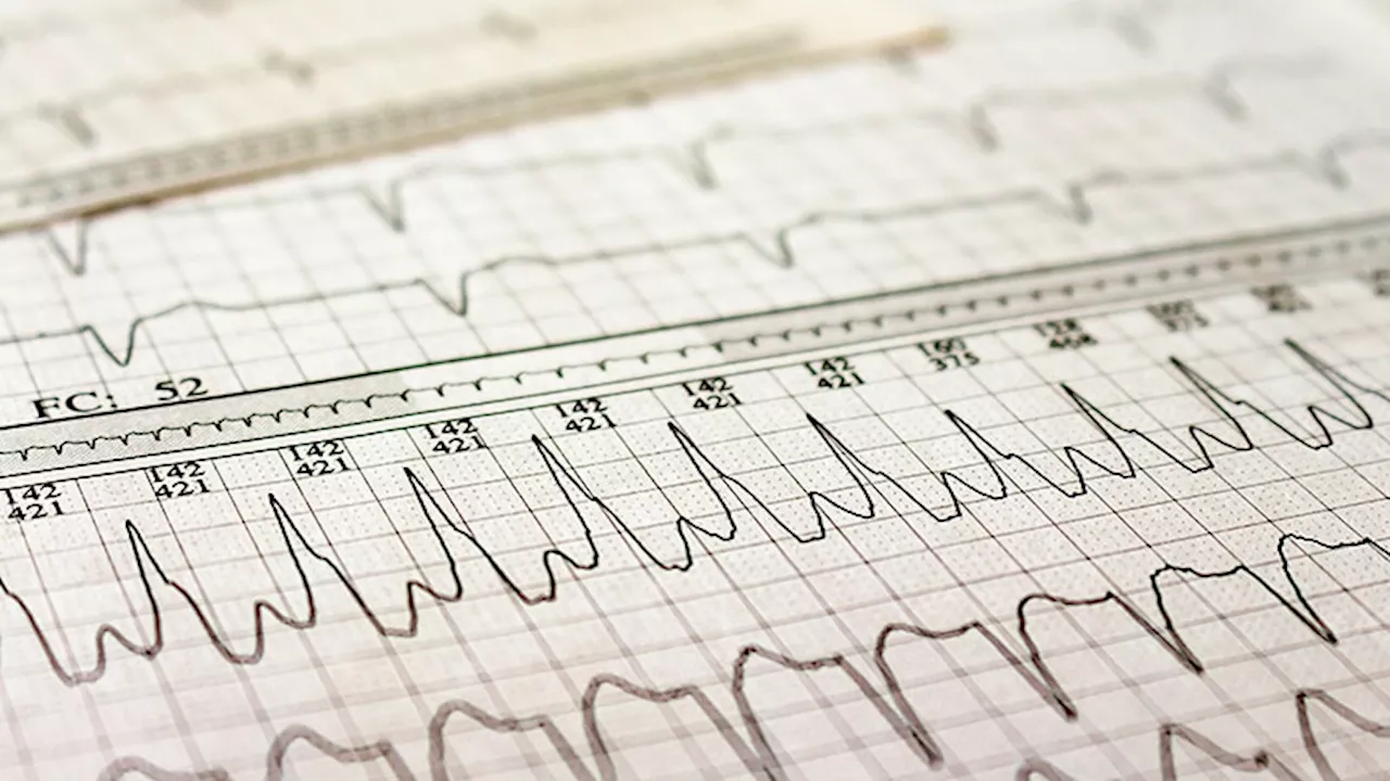 AF Ablation Works…But: The Positive SHAM-PVI Trial