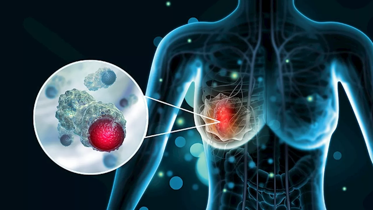 Long-awaited Overall Survival Data Confirm Benefit of Pembrolizumab in TNBC