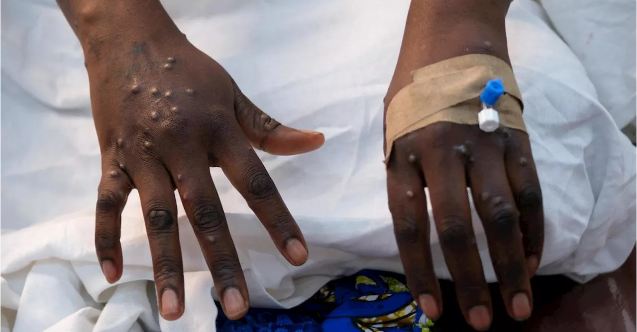 Mpox in Afrika laut Behörden „nicht unter Kontrolle“