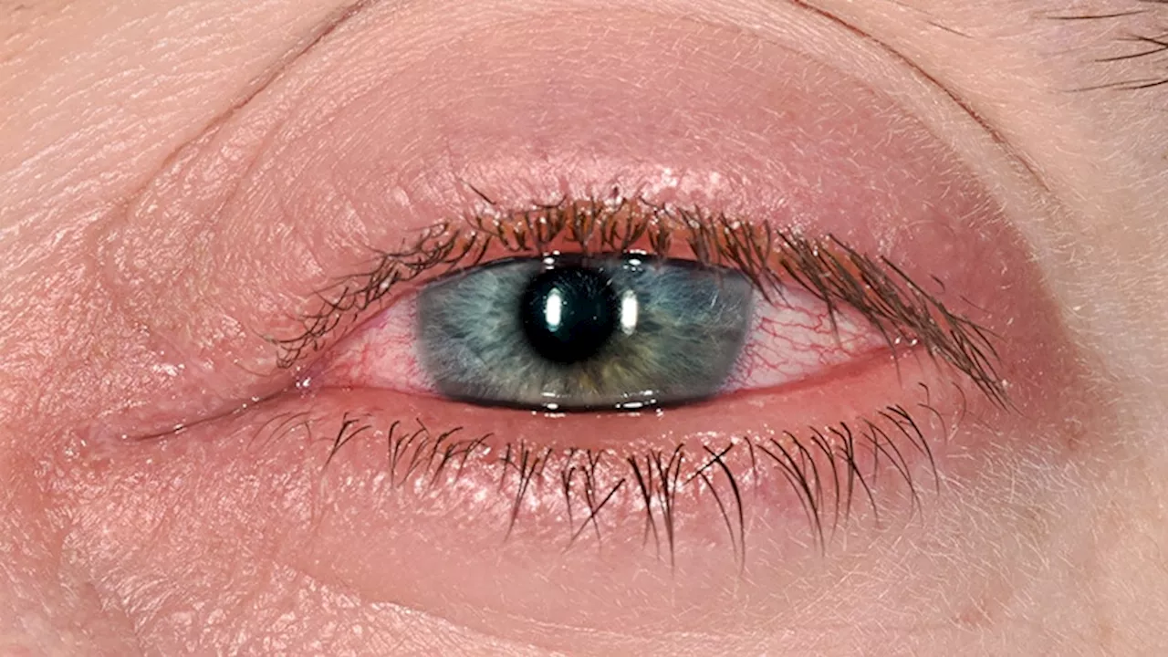 Adalimumab Tops Cyclosporine in Preventing Uveitis Relapse