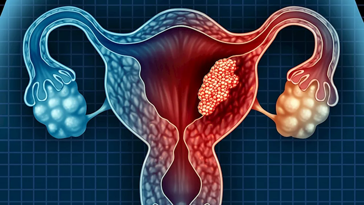 Adjuvant Pembrolizumab in Endometrial Cancer: 'Disappointing' Yet 'Game-Changing'