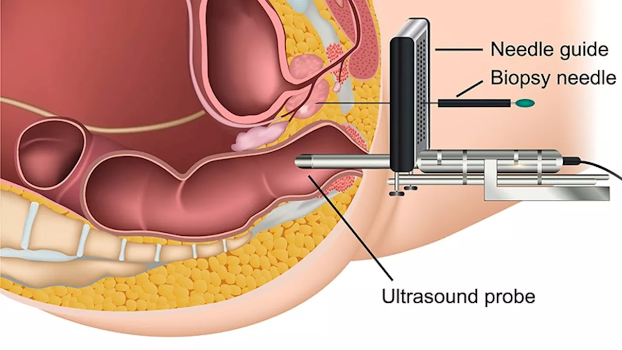 Transperineal Biopsies Show Superior Safety Over Transrectal Method