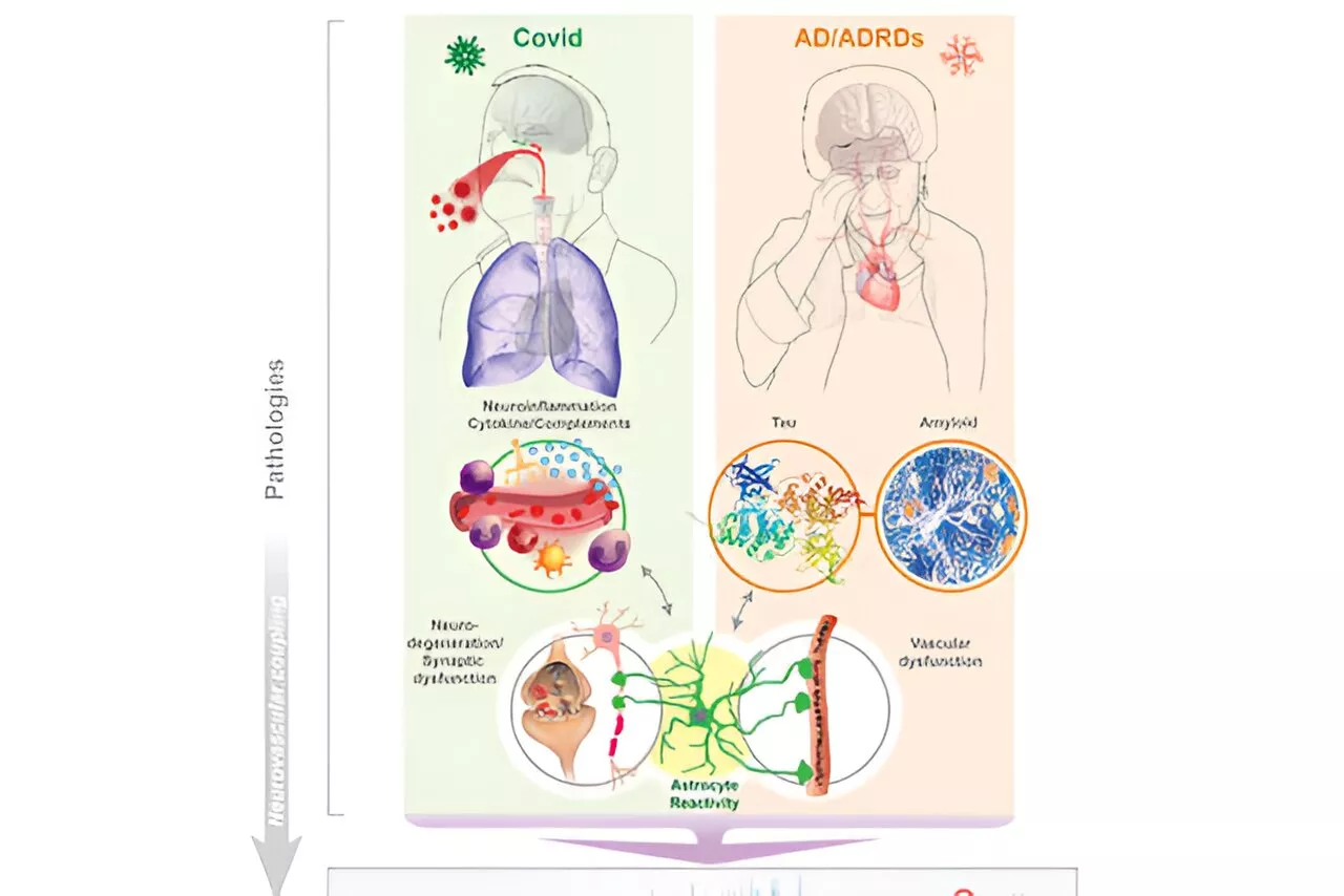 Alzheimer's-like brain changes found in long COVID patients