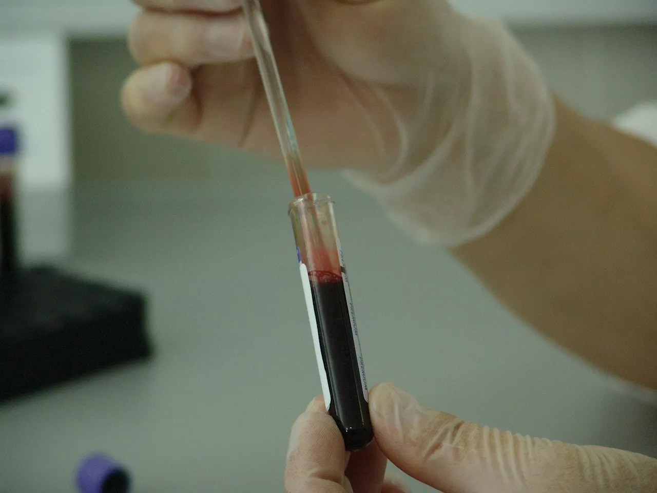 Blood-based assay shows promise for detecting IDH1.R132H-mutant gliomas