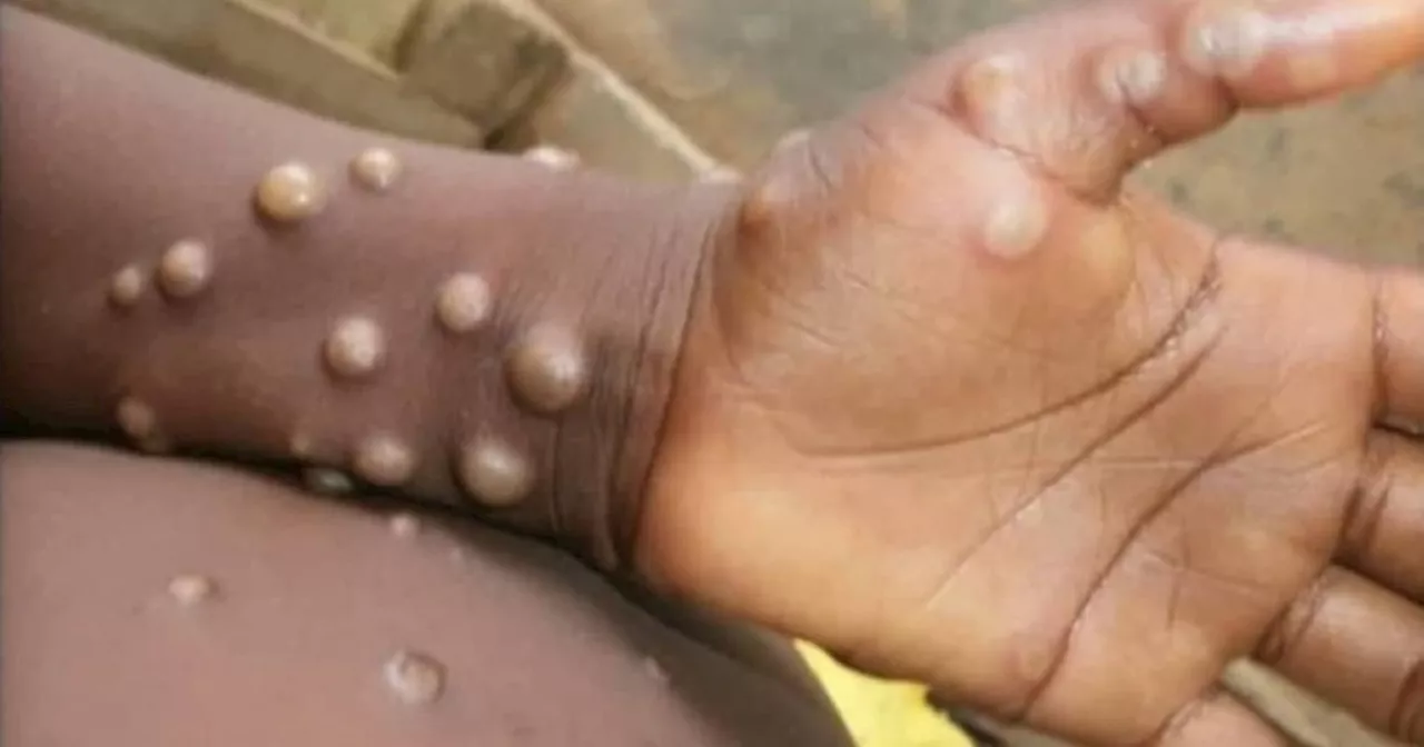 CHO monitors 6 suspected cases of mpox