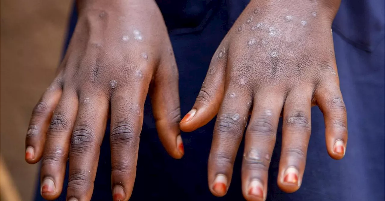 WHO warnt vor rapider Mpox-Ausbreitung in Afrika