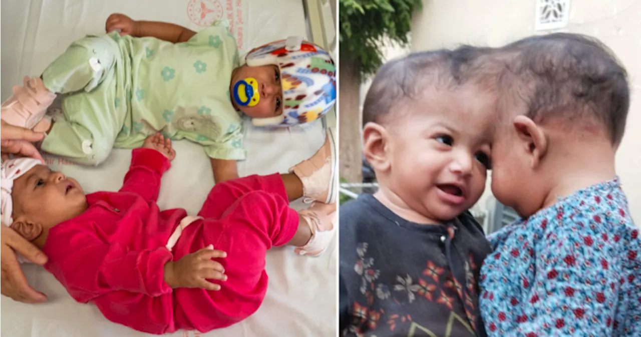 Twins conjoined at the head separated in marathon 14-hour surgery