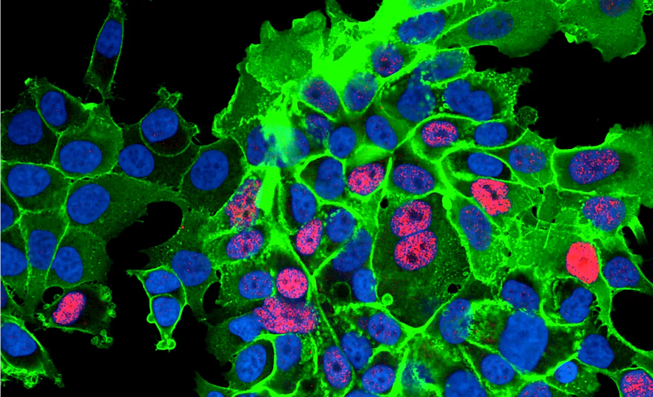 Study: Inflammatory cells in tumor microenvironment transform prostate cancer cells into treatment-resistant cells