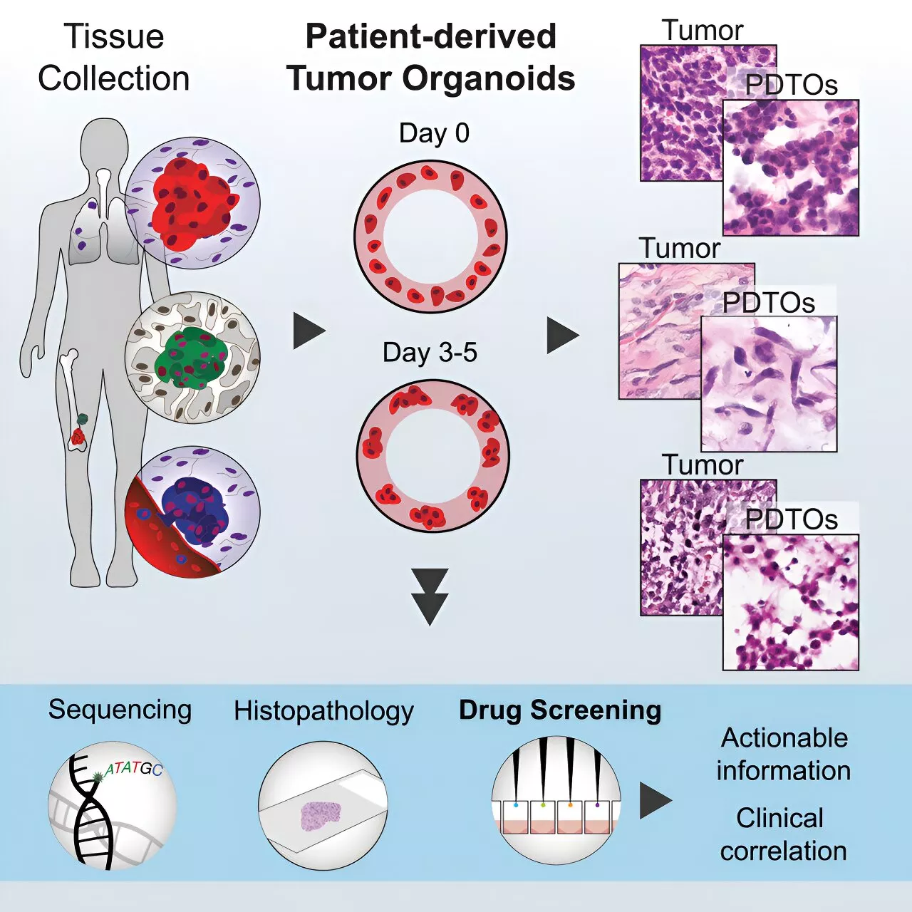 Unlocking the potential of patient-derived organoids for personalized sarcoma treatment