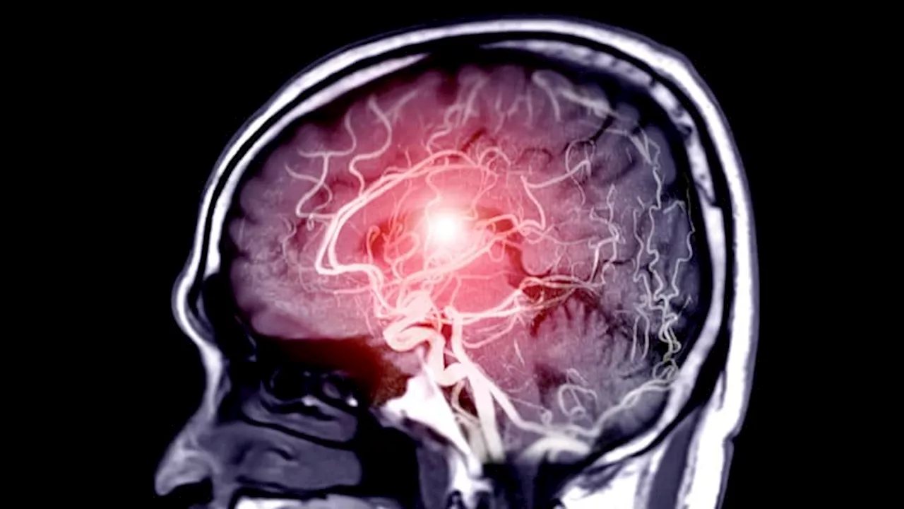 Environmental, Metabolic Factors Driving Global Rise in Stroke