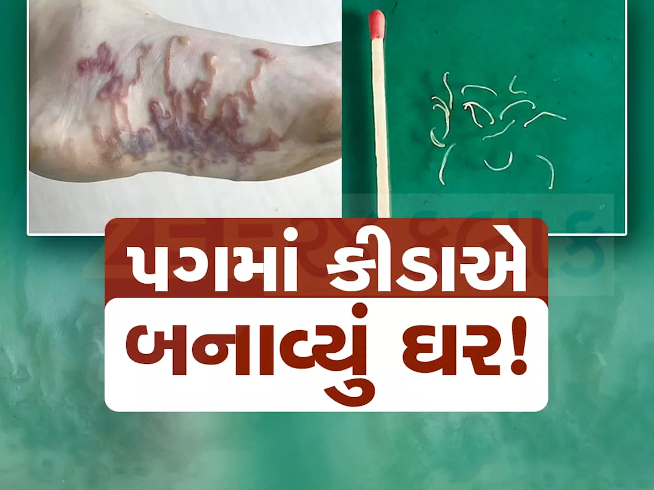 અરેરાટી થઈ જાય તેવો કિસ્સો! 7 વર્ષના બાળકના પગમાં ઘૂસી ગયા કીડા