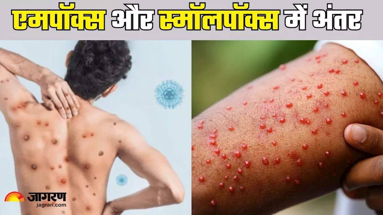 क्या आप भी Mpox और स्मॉलपॉक्स में हो जाते हैं कन्फ्यूज? एक्सपर्ट ने बताया कैसे करें दोनों में अंतर