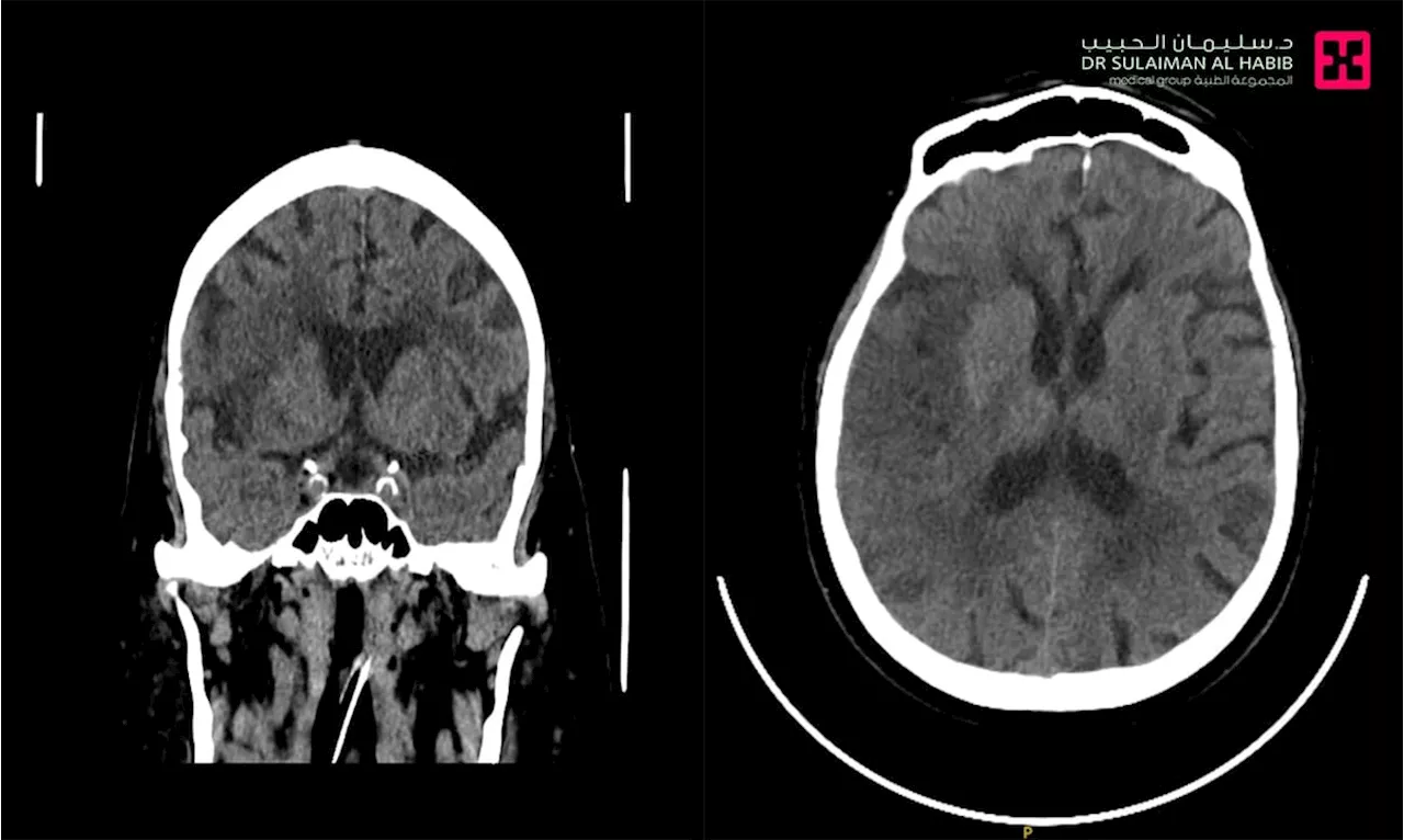 مستشفى الدكتور سليمان الحبيب بالصحافة ينقذ حياة 'سبعيني' مصاب بجلطة وريدية دماغية عميقة بالأشعة التداخلية