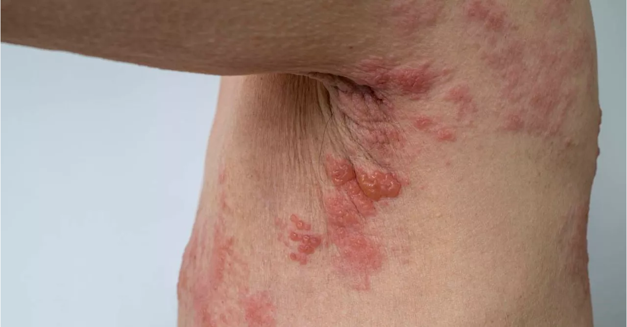 More Australians will be able to get a free vaccine for shingles