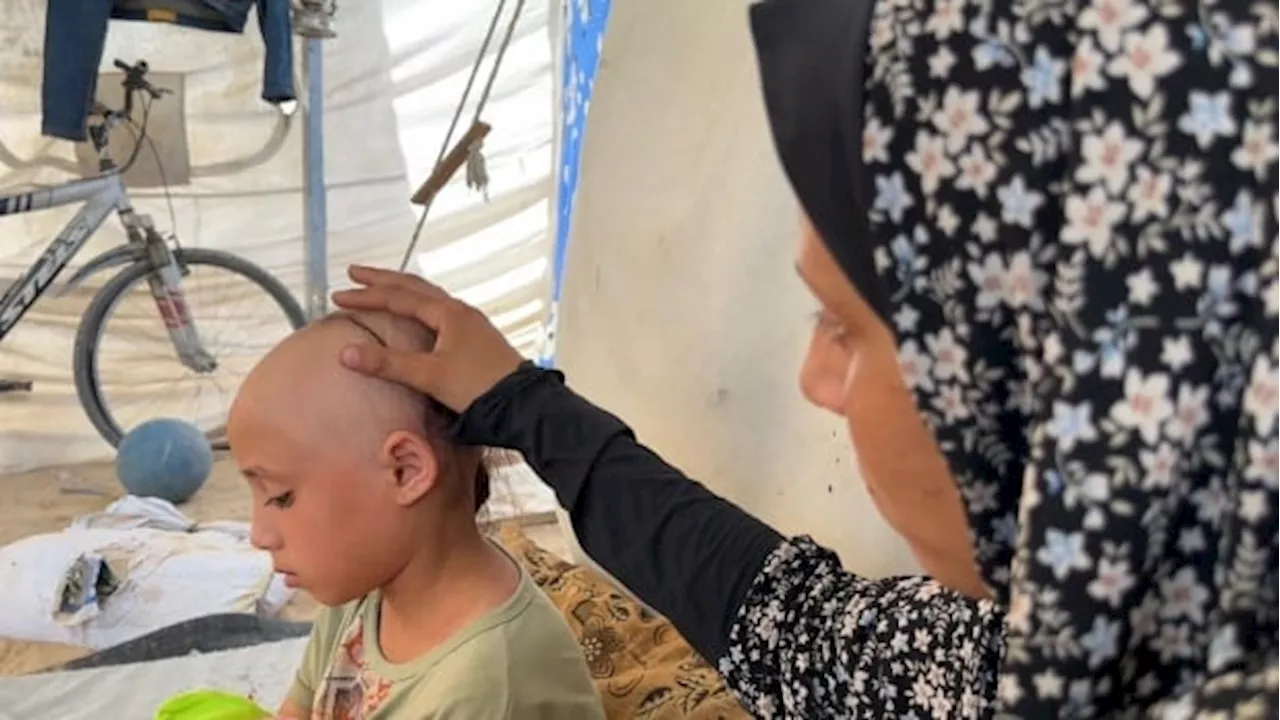 The stress of life in Gaza has taken most of this little girl's hair